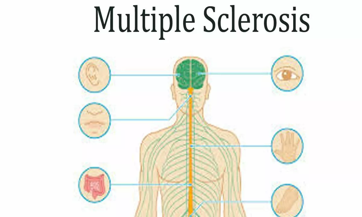 The Connection Between a Burning Sensation and Multiple Sclerosis